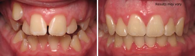 Before and After braces at McCrea DDS